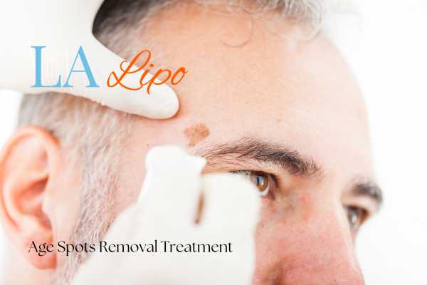 What Are the Most Effective Treatments for Age Spots West Drayton?