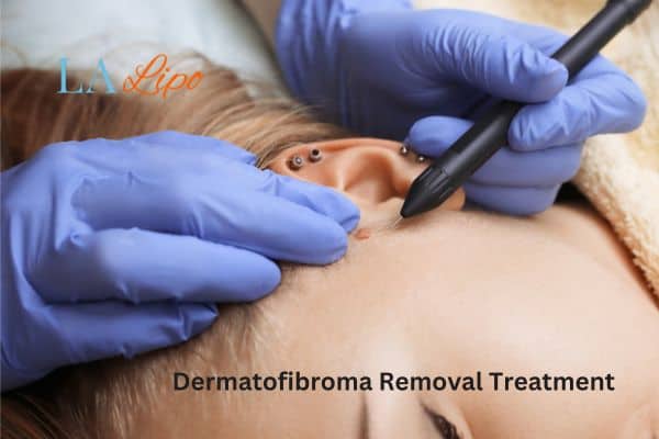 Dermatofibroma Removal Treatment West Drayton