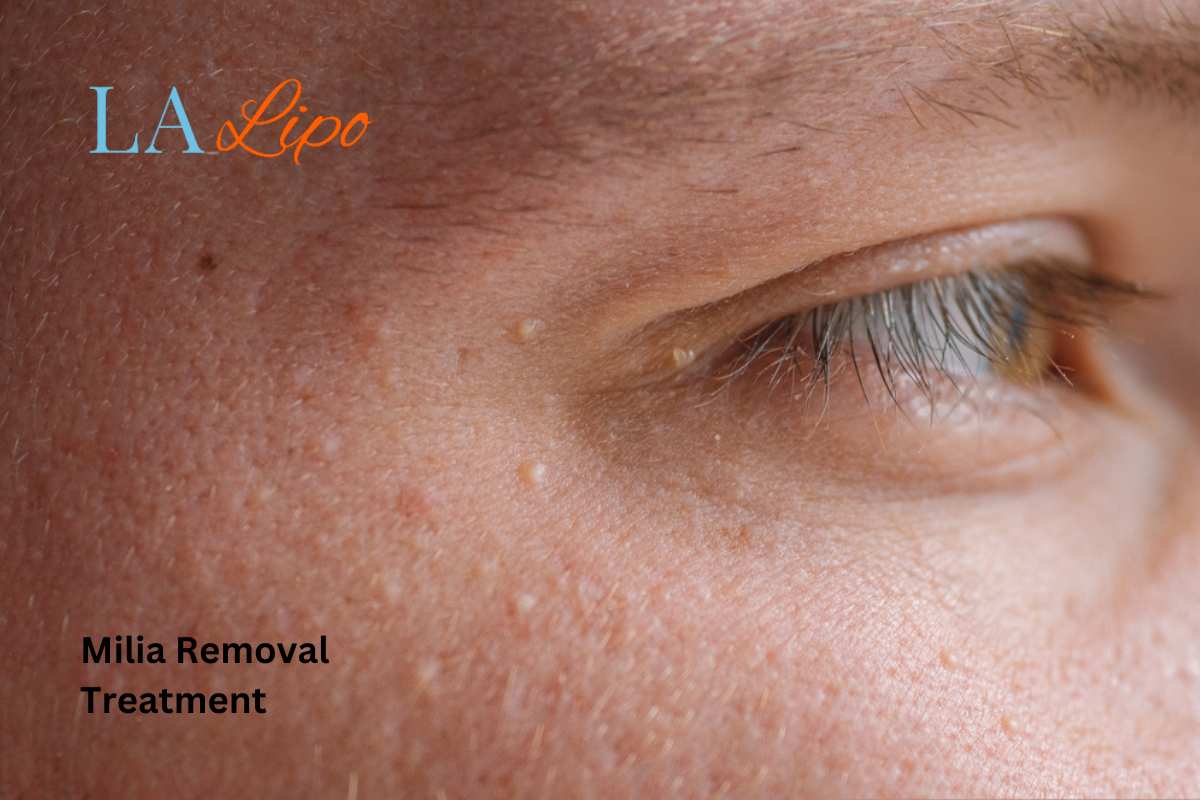 Cryopen Milia Removal: Is It the Easiest and Safest Option West Drayton?