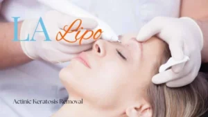 Woman receiving Actinic Keratosis Removal Treatment West Drayton