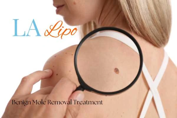 Why getting moles removed West Drayton can boost your confidence!