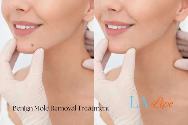 Woman's before and after results of being moles removal treatment West Drayton
