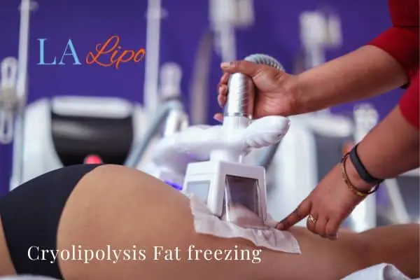 women getting fat freezing West Drayton