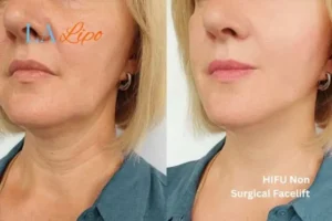 hi-fu for wrinkles West Drayton before and after results