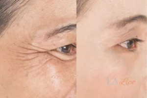 Before and after results of woman - HI-fu wrinkles reduction treatment West Drayton
