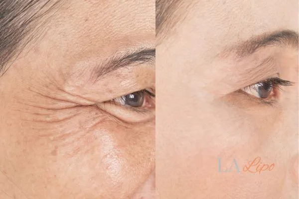 Before and after results of woman - HI-fu wrinkles reduction treatment West Drayton