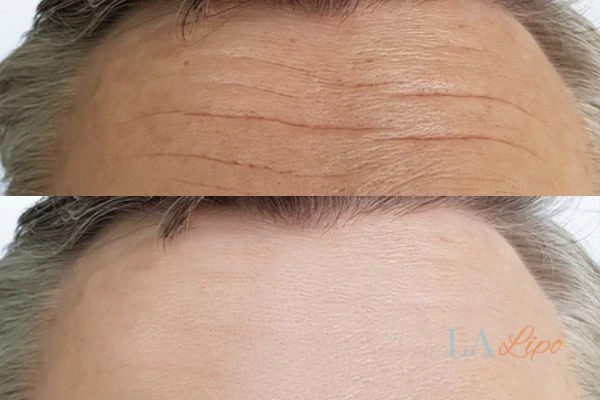 results of HIFU West Drayton on mans forehead to help reduce lines and wrinkles