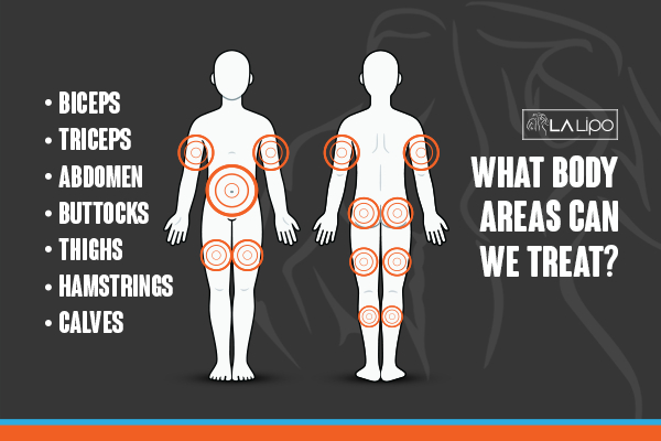 Graphic to show areas you can have LA-EMS Body Sculpting West Drayton treatment.