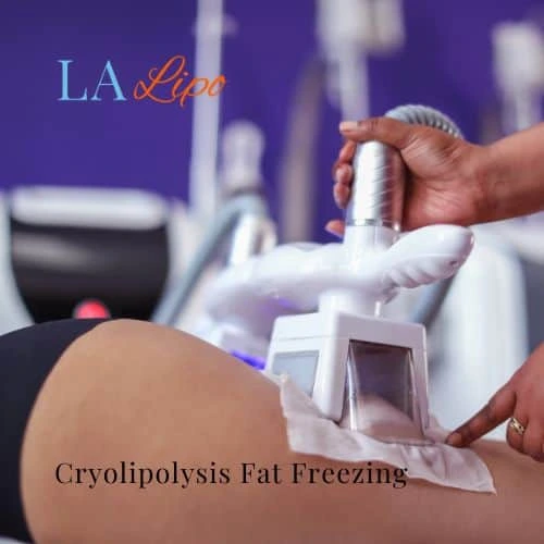 fat freezing - Cryolipolysis West Drayton