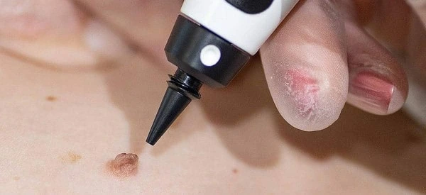 skin tag removal using cryopen West Drayton
