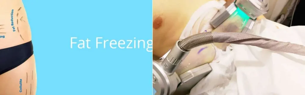 Fat freezing West Drayton on multiple areas of the body