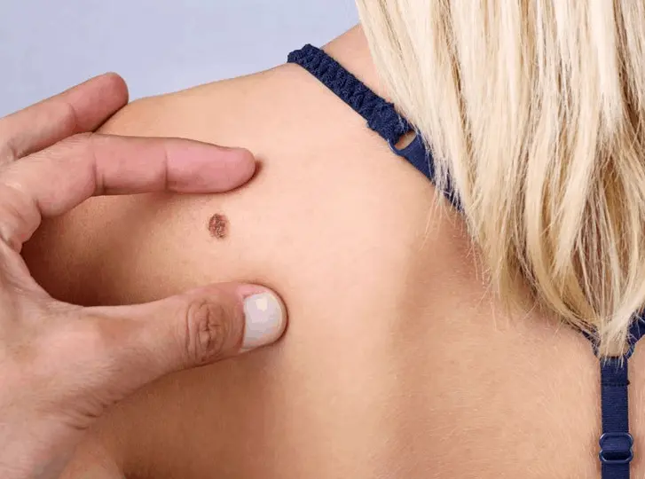 woman having mole removal West Drayton consultation before treatment.
