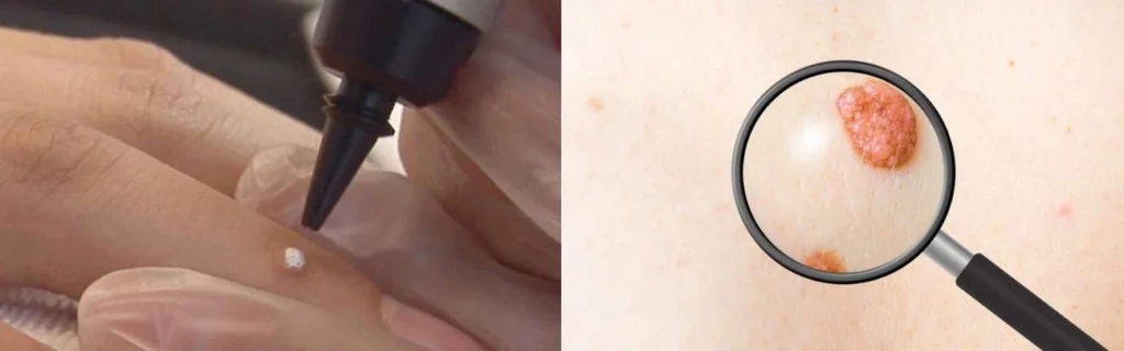 Person getting moles removed with cryopen West Drayton