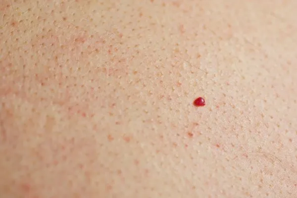 close up of a cherry angioma West Drayton