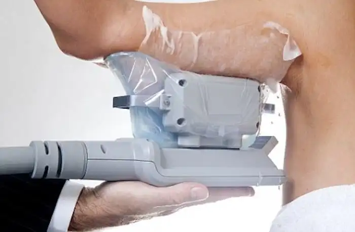 Picture of fat freezing West Drayton on the upper arms.