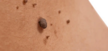 image of a skin tag West Drayton