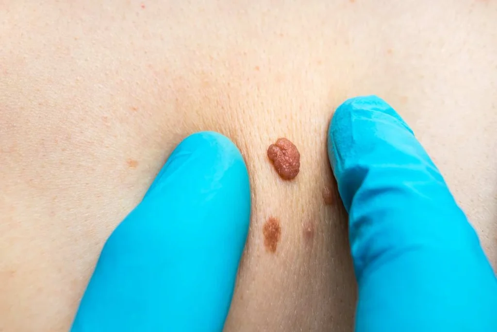 Consultant examining a skin tag West Drayton
