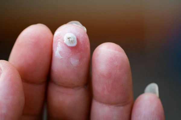 wart on person finger - cryotherapy to treat from LA LIPO West Drayton