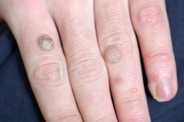 photo of warts on person hand - see wart removal West Drayton from LA LIPO