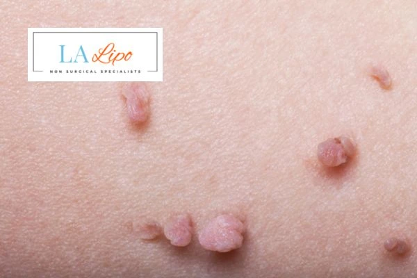 Does cryopen skin tag removal West Drayton hurt? Find out now call our team today!