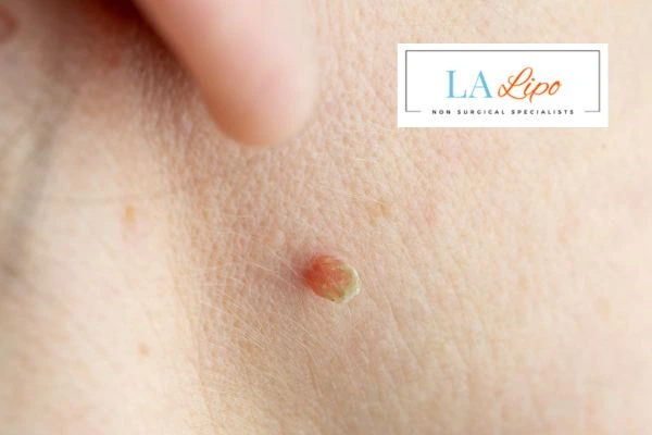 Book skin tag removal West Drayton today speak to our team now!