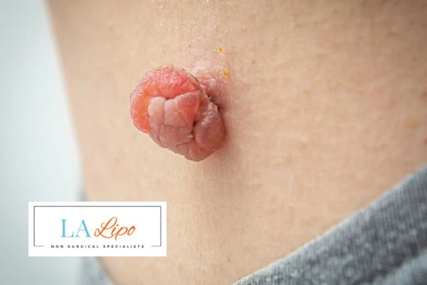 Interested in skin tag removal West Drayton? Concerned about the pain? Find out more today!