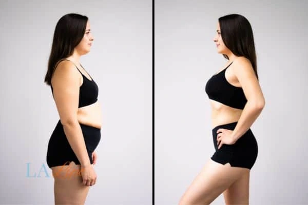 Picture of womans before and after using LA-EMS body sculpting to improve her core strength West Drayton