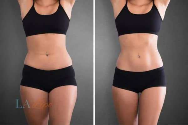 before and after results of non-surgical treatment to help a woman's body image and mental health West Drayton