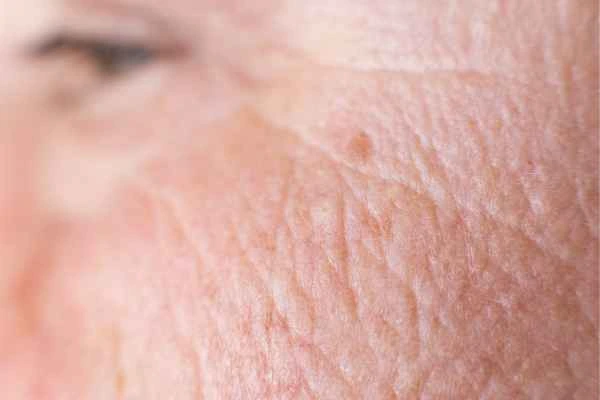 close up picture of a woman's face showing an age spot West Drayton