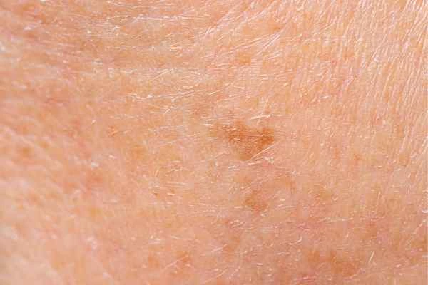 close up picture of age spots West Drayton