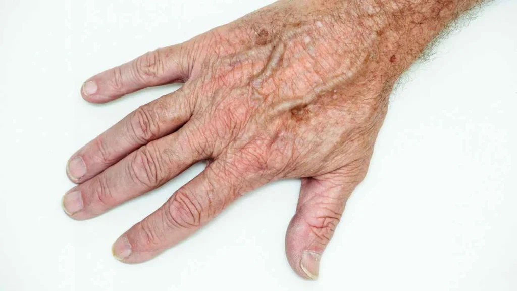 Male hand showing age spot West Drayton