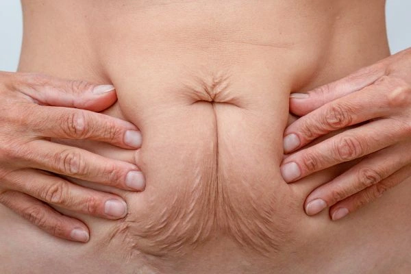 Image of a woman's stomach with loose skin - example of skin tightening West Drayton options