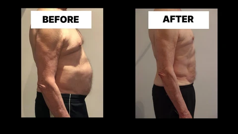 What Symptoms Can Diastasis Recti Cause in Men? Weak Core, Back Pain and Poor Posture West Drayton